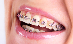 Types of Braces - Dr. Walker Orthodontics